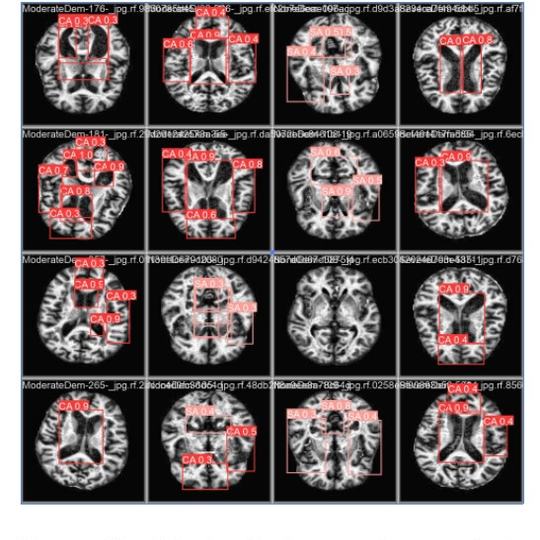 Ressonância magnética - pesquisa IA e Alzheimer 3
